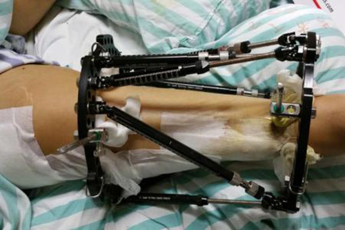 總結(jié)碳纖維聚醚醚酮復(fù)合材料的5點(diǎn)優(yōu)勢(shì)