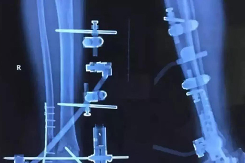 碳纖維假肢應(yīng)用價(jià)值如何？