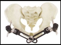 熱塑性PEEK碳纖維骨科固定架優(yōu)勢(shì)