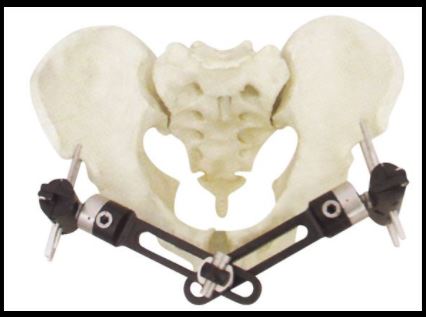 熱塑性PEEK碳纖維骨科固定架